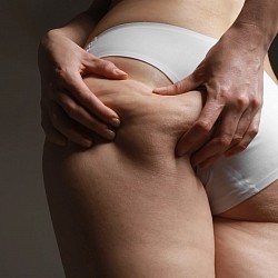 cellulite